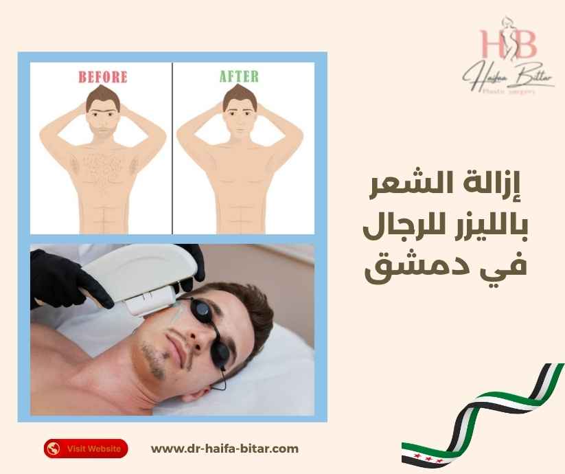 إزالة الشعر بالليزر للرجال في دمشق