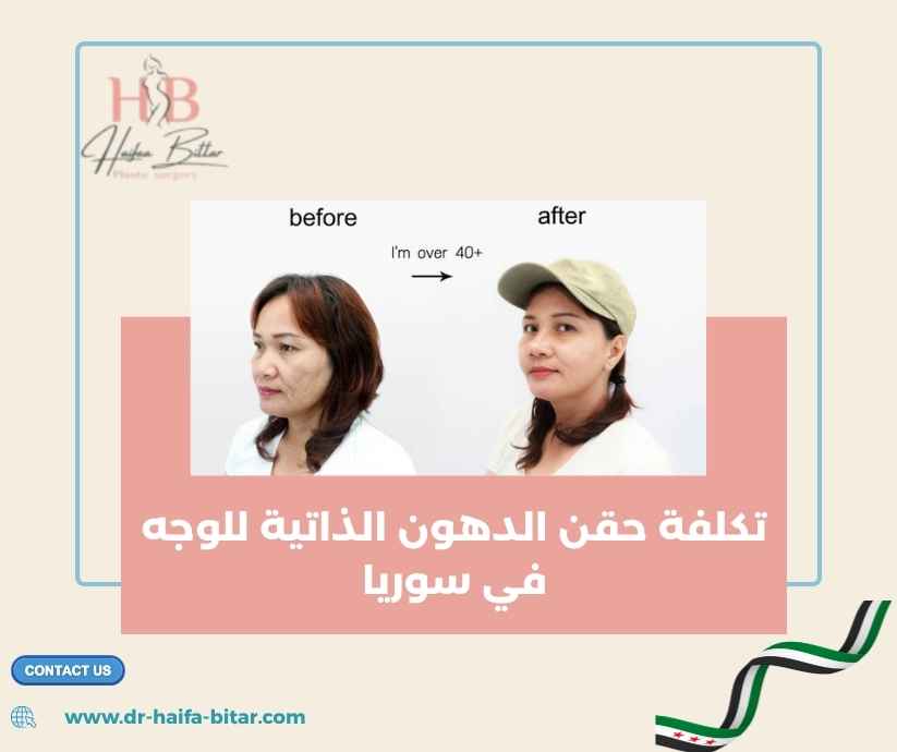 تكلفة حقن الدهون الذاتية للوجه في سوريا