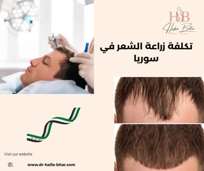 تكلفة زراعة الشعر في سوريا