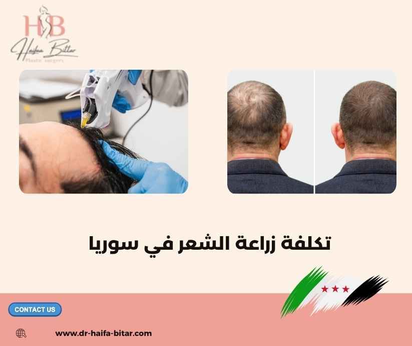 تكلفة زراعة الشعر في سوريا