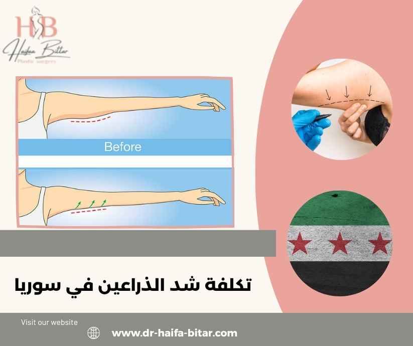 تكلفة شد الذراعين في سوريا تكلفة شد الذراعين في سوريا