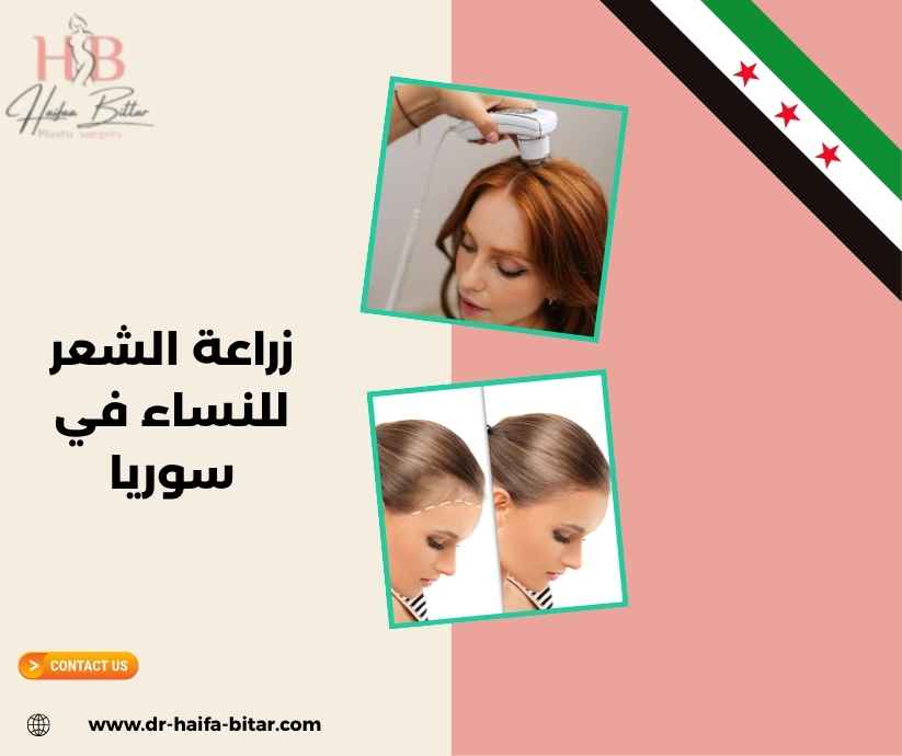 زراعة الشعر للنساء في سوريا