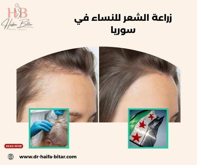 زراعة الشعر للنساء في سوريا