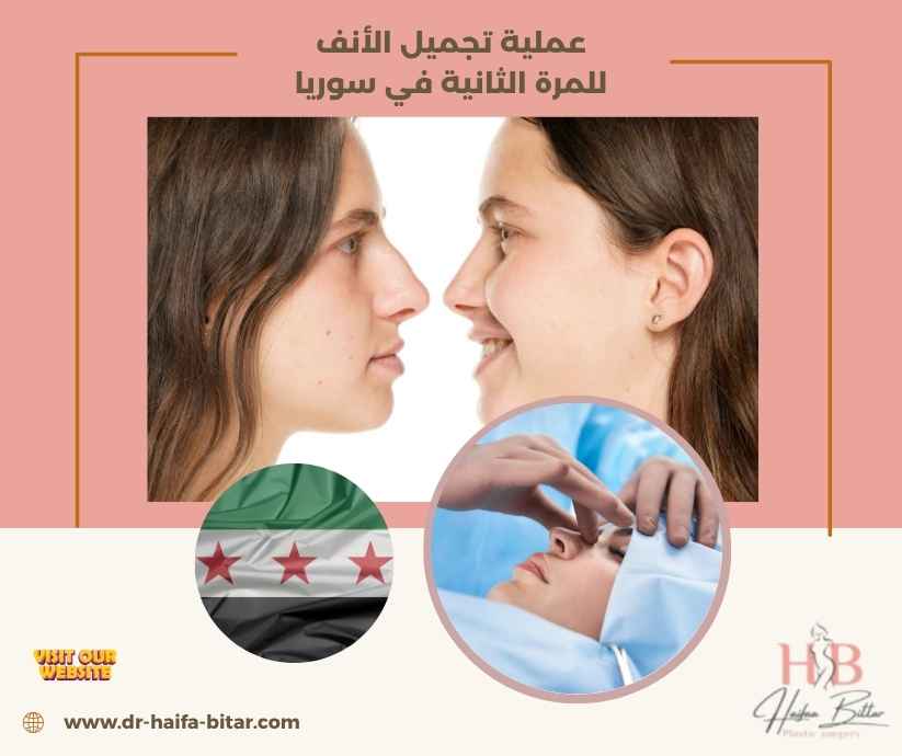 عملية تجميل الأنف للمرة الثانية في سوريا