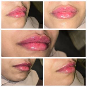 تجميل شفايف بيد الدكتورة هيفاء بيطار 